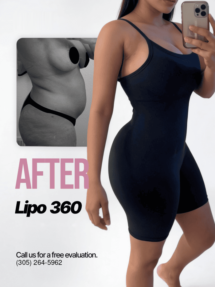 Tummy tuck before and after