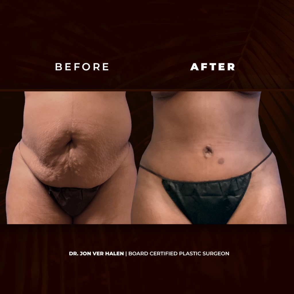 Before and After photos after liposuction procedure.