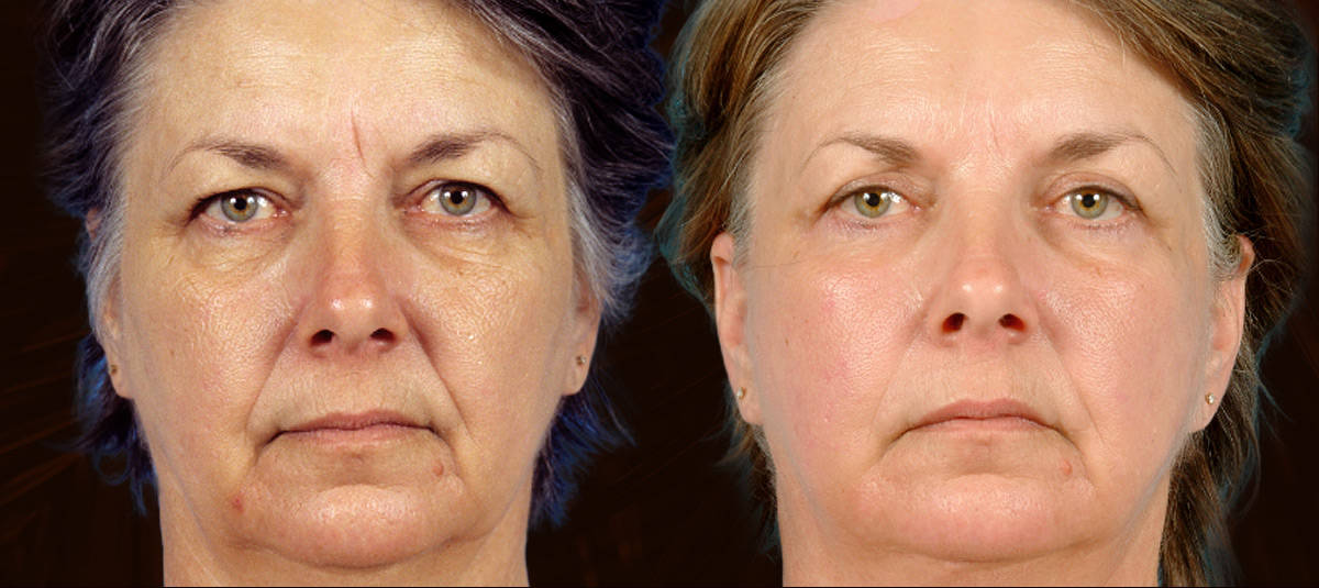Blepharoplasty-Menu-Image