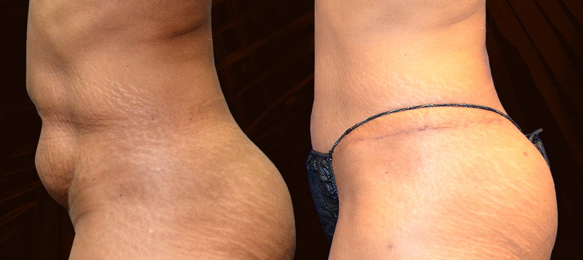 Liposuction-Menu-Image