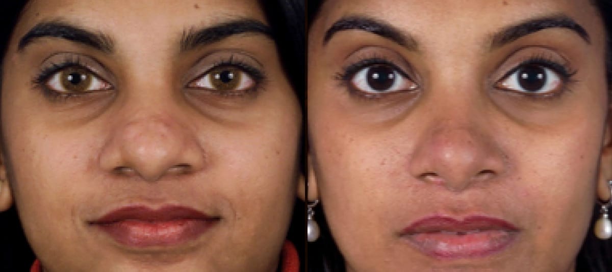 Rhinoplasty-Menu-Image