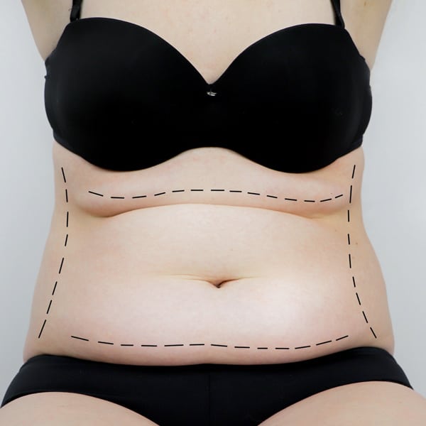 Tummy Tuck